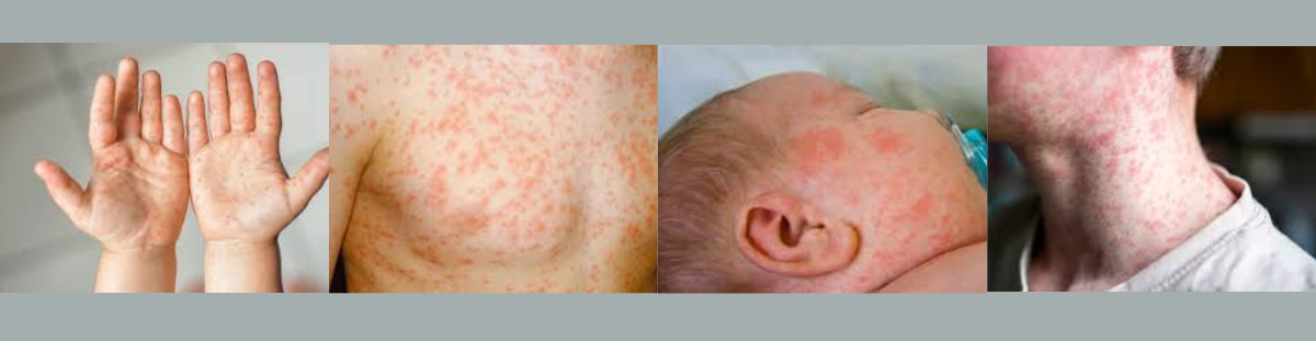 Measles Banner 2